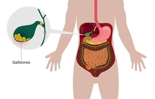 Gallbladder Surgery