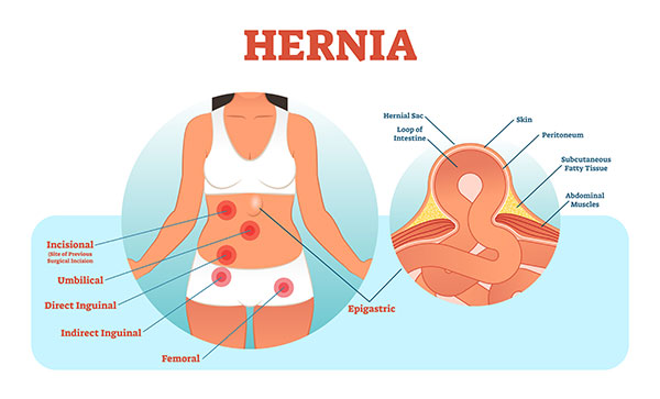 Abdominal hernia: what is it, types, surgery and postoperative period